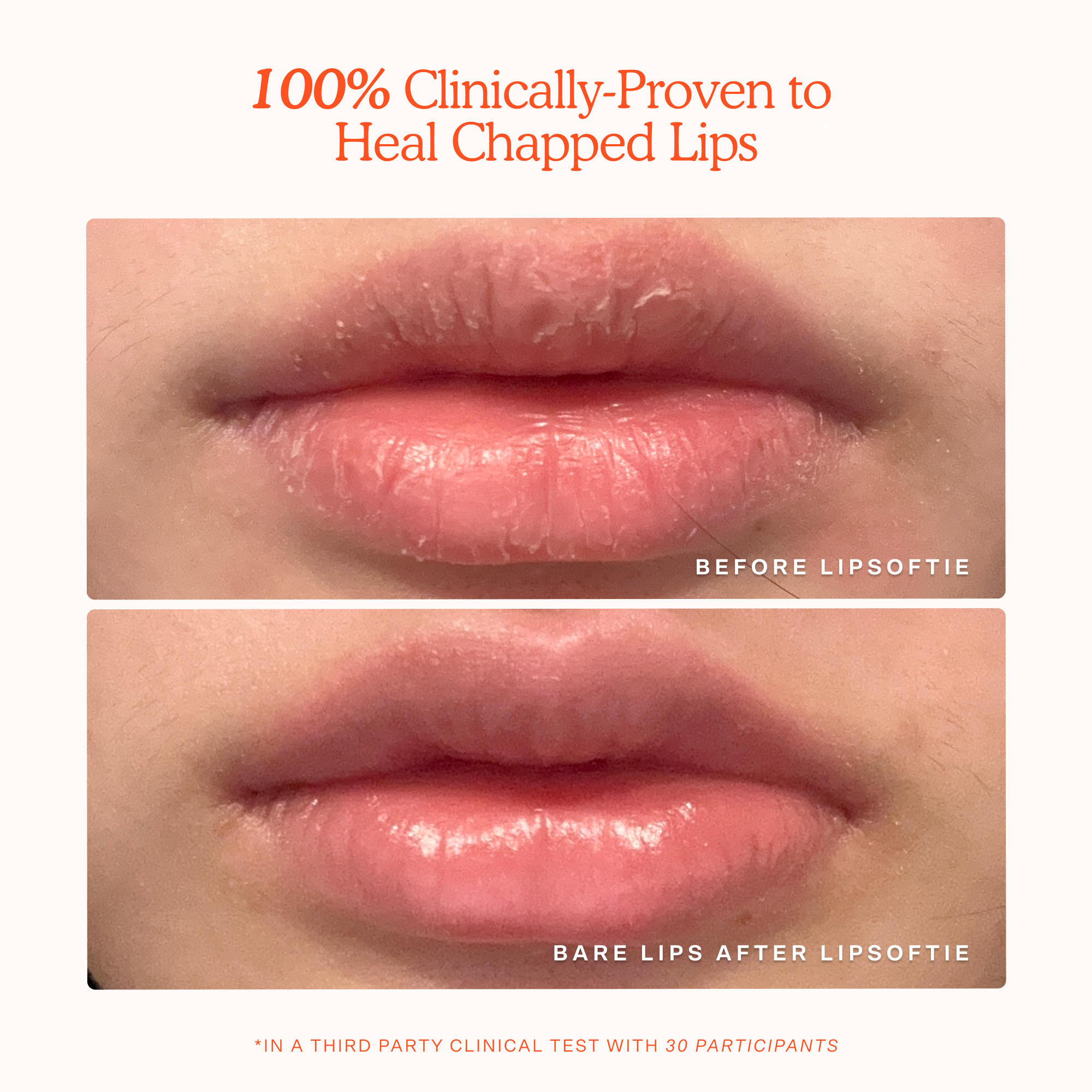 LipSoftie® Comfort lip treatment