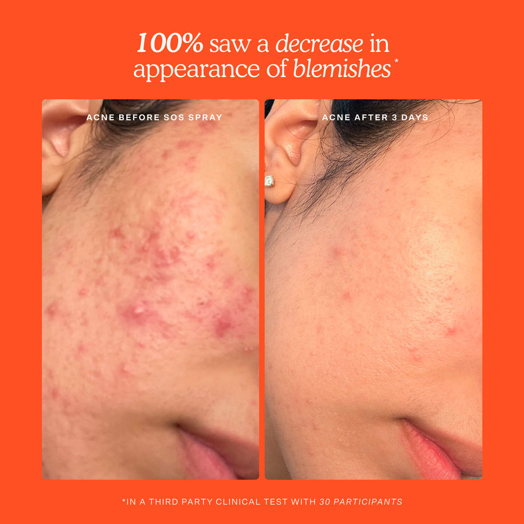 SOS Mini Routine skincare minis kit