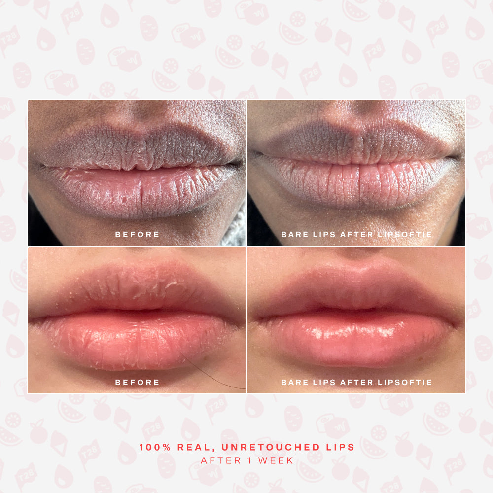 SOS LipSoftie® Comfort lip treatment