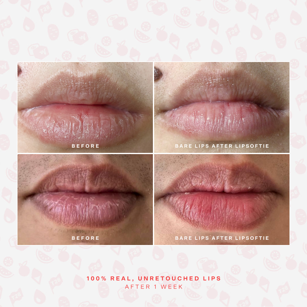 SOS LipSoftie® Comfort lip treatment